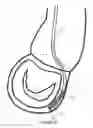 Fig. 13 - METHOD AND APPARATUS FOR MITRAL VALVE ANNULOPLASTY