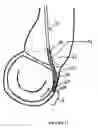 Fig. 14 - METHOD AND APPARATUS FOR MITRAL VALVE ANNULOPLASTY
