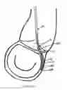 Fig. 15 - METHOD AND APPARATUS FOR MITRAL VALVE ANNULOPLASTY