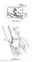 Fig. 16 - METHOD AND APPARATUS FOR MITRAL VALVE ANNULOPLASTY