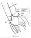 Fig. 18 - METHOD AND APPARATUS FOR MITRAL VALVE ANNULOPLASTY