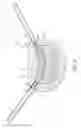Fig. 06 - Nuclear implant apparatus and method following partial nuclectomy