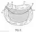 Fig. 07 - Nuclear implant apparatus and method following partial nuclectomy