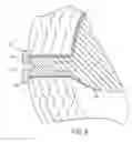 Fig. 09 - Nuclear implant apparatus and method following partial nuclectomy