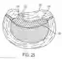 Fig. 16 - Nuclear implant apparatus and method following partial nuclectomy