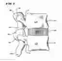 Fig. 02 - Facet arthoplasty devices and methods