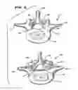Fig. 03 - Facet arthoplasty devices and methods