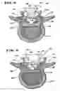 Fig. 04 - Facet arthoplasty devices and methods