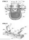 Fig. 05 - Facet arthoplasty devices and methods