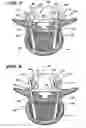 Fig. 06 - Facet arthoplasty devices and methods