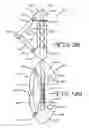 Fig. 03 - Minimally invasive collapsible cage