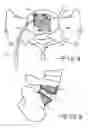 Fig. 06 - Minimally invasive collapsible cage