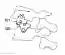 Fig. 01 - Lateral spondylolisthesis reduction cage