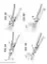 Fig. 05 - Lateral spondylolisthesis reduction cage
