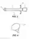 Fig. 03 - Graft delivery system and methods thereof