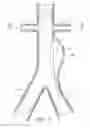 Fig. 02 - Apparatus and method of placement of a graft or graft system