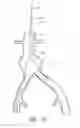 Fig. 14 - Apparatus and method of placement of a graft or graft system