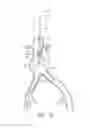 Fig. 15 - Apparatus and method of placement of a graft or graft system