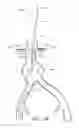 Fig. 16 - Apparatus and method of placement of a graft or graft system