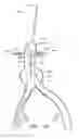 Fig. 17 - Apparatus and method of placement of a graft or graft system