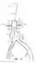 Fig. 18 - Apparatus and method of placement of a graft or graft system