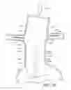 Fig. 31 - Apparatus and method of placement of a graft or graft system
