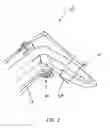 Fig. 03 - FRAGMENT SPECIFIC FRACTURE REDUCTION BRACE AND ASSOCIATED METHOD OF USE