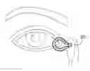 Fig. 01 - Lacrimal stent