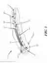 Fig. 05 - Methods and devices for applying closed incision negative pressure wound therapy