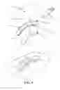 Fig. 06 - Methods and devices for applying closed incision negative pressure wound therapy