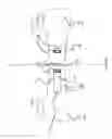 Fig. 43 - Methods and devices for applying closed incision negative pressure wound therapy