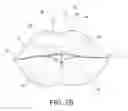 Fig. 04 - Lip enhancement and enlargement device
