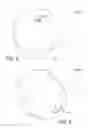 Fig. 17 - Lip enhancement and enlargement device