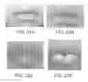 Fig. 25 - Lip enhancement and enlargement device