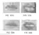 Fig. 30 - Lip enhancement and enlargement device