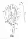 Fig. 09 - Method of removing excess fluid from a patient with hemodilution