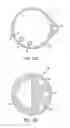 Fig. 14 - Method of removing excess fluid from a patient with hemodilution