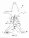 Fig. 25 - Method of removing excess fluid from a patient with hemodilution
