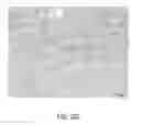 Fig. 29 - Method of removing excess fluid from a patient with hemodilution