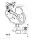 Fig. 10 - Intravascular ventricular assist device