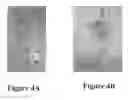 Fig. 05 - Continuous implantable peritoneal dialysis