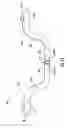 Fig. 09 - ARTERIOVENOUS ACCESS VALVE SYSTEM WITH SEPARATE VALVE TUBES