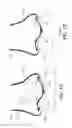 Fig. 15 - Cannula for minimizing dilution of dosing during nitric oxide delivery
