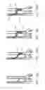 Fig. 22 - DEVICES AND METHODS FOR TREATING LOWER EXTREMITY VASCULATURE