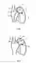 Fig. 05 - Retrievable devices for treating heart failure
