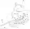 Fig. 01 - SURGICAL GUIDE AND METHOD FOR GUIDING A THERAPY DELIVERY DEVICE INTO THE PTERYGOPALATINE FOSSA