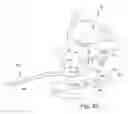 Fig. 22 - SURGICAL GUIDE AND METHOD FOR GUIDING A THERAPY DELIVERY DEVICE INTO THE PTERYGOPALATINE FOSSA