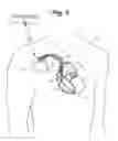 Fig. 02 - CONNECTIVITY DETECTION AND TYPE IDENTIFICATION OF AN IMPLANTED LEAD FOR AN IMPLANTABLE MEDICAL DEVICE