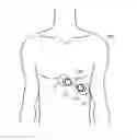 Fig. 01 - Patch including an external floating high-pass filter and an electrocardiograph (ECG) patch including the same
