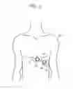 Fig. 03 - Patch including an external floating high-pass filter and an electrocardiograph (ECG) patch including the same